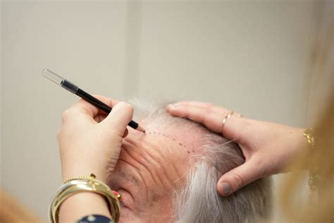 Haartransplantatie DHI: De Innovatieve Techniek