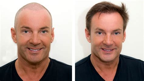 Haartransplantatie En Genetica: Hoe Beïnvloedt Het Je?