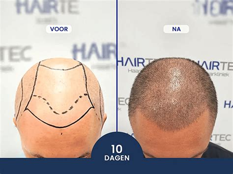 Haartransplantatie Kosten: Wat Zijn De Factoren?