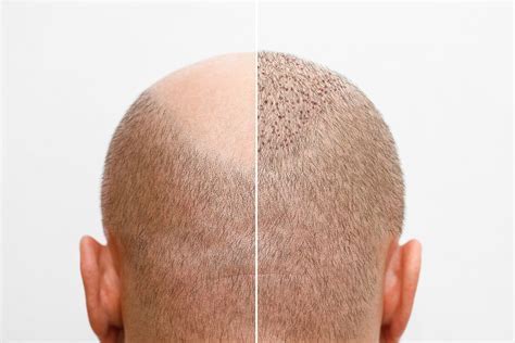Nazorg Na Een Haartransplantatie: Tips En Adviezen